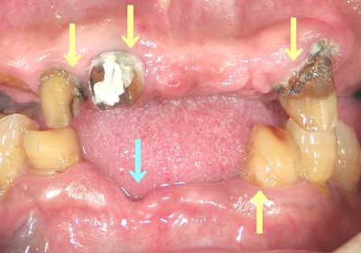 重度の歯周病写真