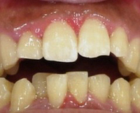 歯肉炎の歯茎（はぐき）