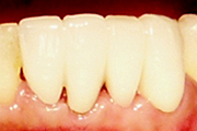 症例2：歯肉移植術（結合組織移植術）