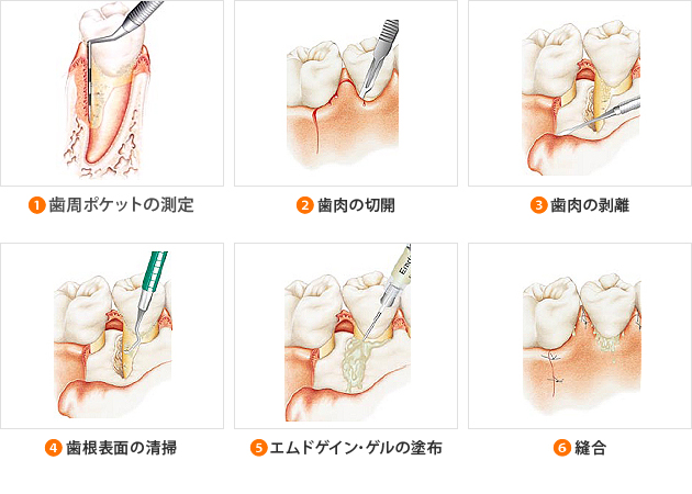 専門性の高い安心安全の歯周再生療法は名古屋市の歯周病ガイドへ